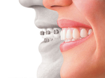 The image is a composite graphic displaying two halves of a smiling face with teeth, one on each side, connected by an image of a dental implant bridge.