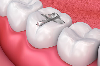 The image depicts a close-up of a human dental implant integrated into an artificial tooth within a mouth with natural teeth, set against a pink background that resembles gum tissue.