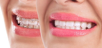 The image shows two views of a person's mouth with teeth, set against a white background.