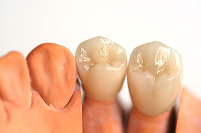Three artificial teeth with visible enamel and gum detail.