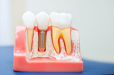 The image shows a model of a dental implant procedure with artificial teeth, screws, and gum tissue displayed on a pink base.
