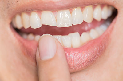 The image shows a close-up view of a person's mouth with teeth and lips, holding a finger in front of their teeth, which appears to be pointing at a dental implant.