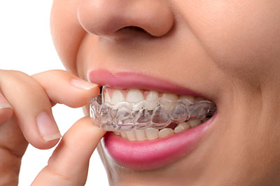 The image shows a person with a smile, holding a dental retainer between their teeth while looking at the camera.