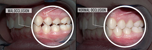 The image shows two photographs of a person's teeth undergoing dental reconstruction.