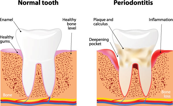 The image presents a detailed illustration of tooth decay progression from normal to severe stages, emphasizing the importance of oral hygiene and dental health.