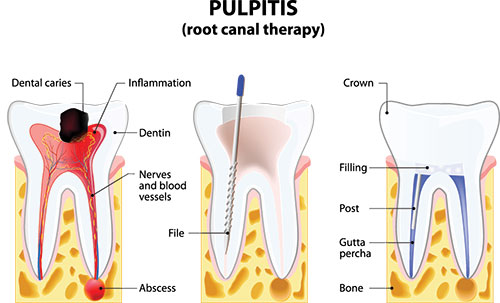 The image shows a diagrammatic illustration of tooth pulpitis with annotations pointing out various parts of the tooth, including dental caries, inflammation, and the presence of bacteria.