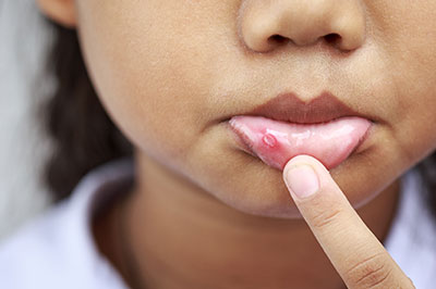 A young child with a pimple on their face pointing at it with their finger.