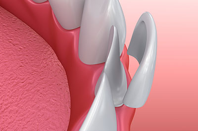 The image displays a close-up view of a dental implant with a screw visible on top of a pink gum background, which suggests a medical or dental context.