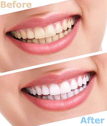 The image shows a before-and-after comparison of teeth whitening, with two photographs side by side: on the left, a person's smile with yellowed teeth; and on the right, the same person's smile after teeth whitening, revealing brighter, cleaner teeth.