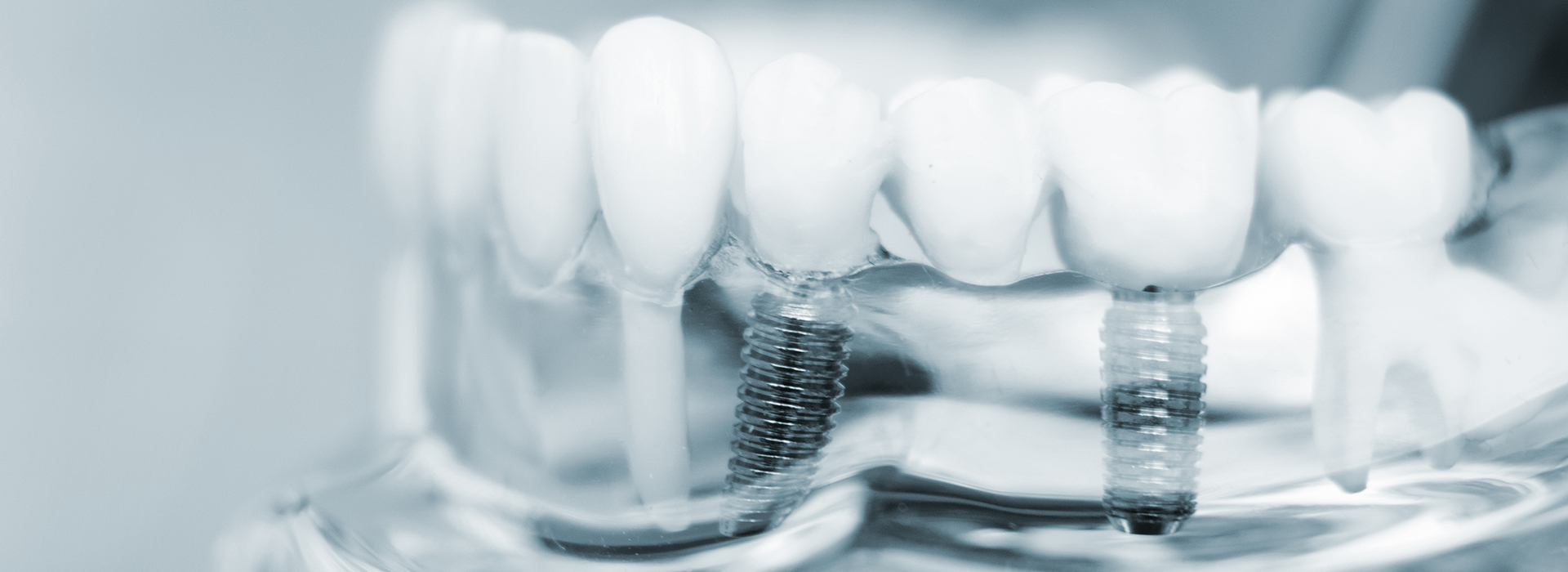 The image shows a close-up view of multiple dental implants with visible screws against a blurred background.