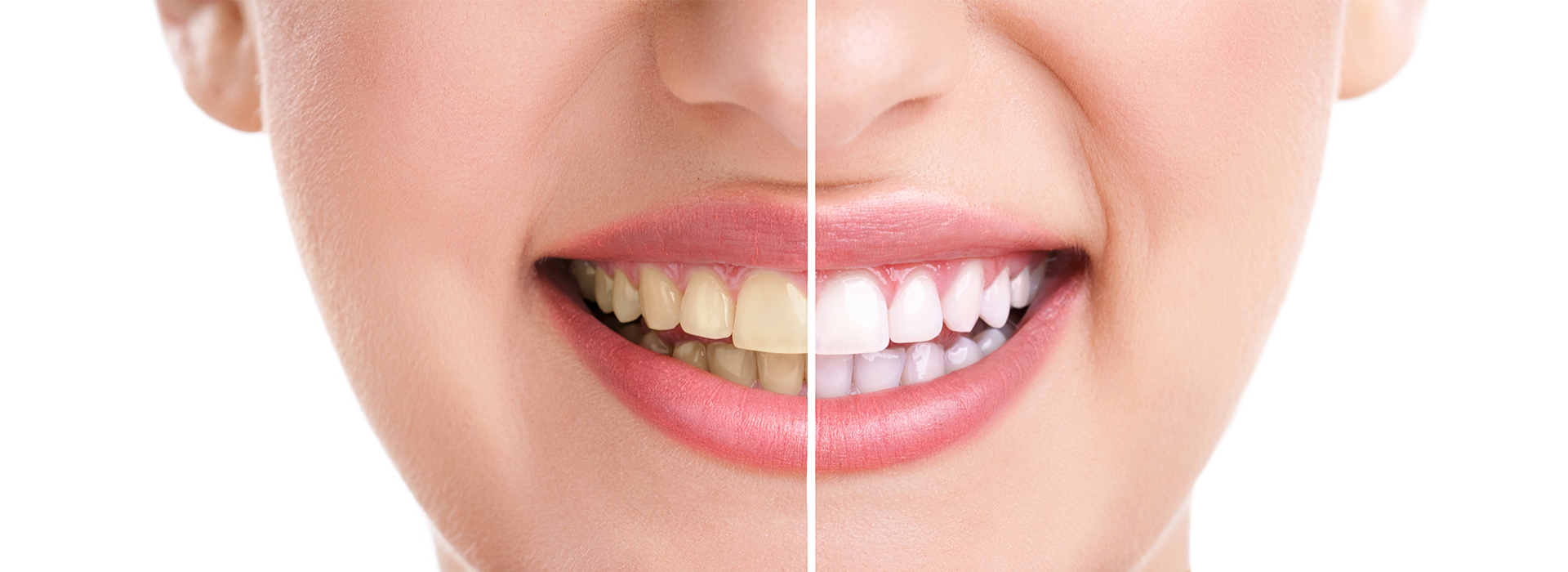 The image shows a close-up of a person's face with a focus on their teeth, which are being straightened through the use of clear braces.