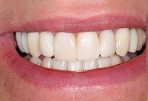 The image shows a close-up view of a person's smiling mouth with straight white teeth, revealing a clean and healthy oral hygiene.