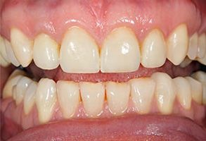 The image shows a close-up view of teeth with yellowing and staining, which suggests possible dental issues such as plaque buildup or discoloration.