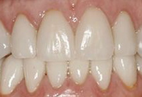 The image displays a close-up view of a person's teeth with visible staining, showcasing the upper and lower front teeth prominently.