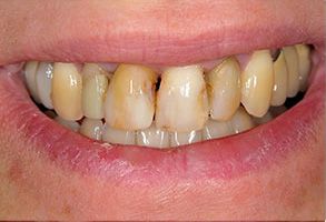 The image shows a person's smile with yellowed teeth, which suggests dental issues such as staining or discoloration.