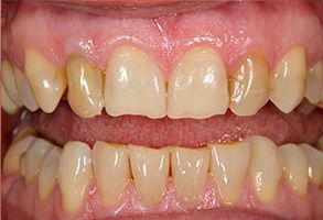 The image shows a close-up view of a person's teeth with visible yellowing and staining, which suggests poor oral hygiene or discoloration.