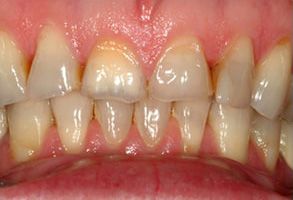 The image shows a close-up view of a person's mouth with teeth that appear to be discolored or stained, possibly due to dental issues such as plaque buildup or tooth decay.